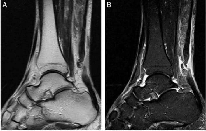 diagnosi della rottura del tendine d'achille