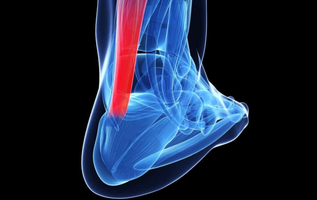 il tendine d'achille