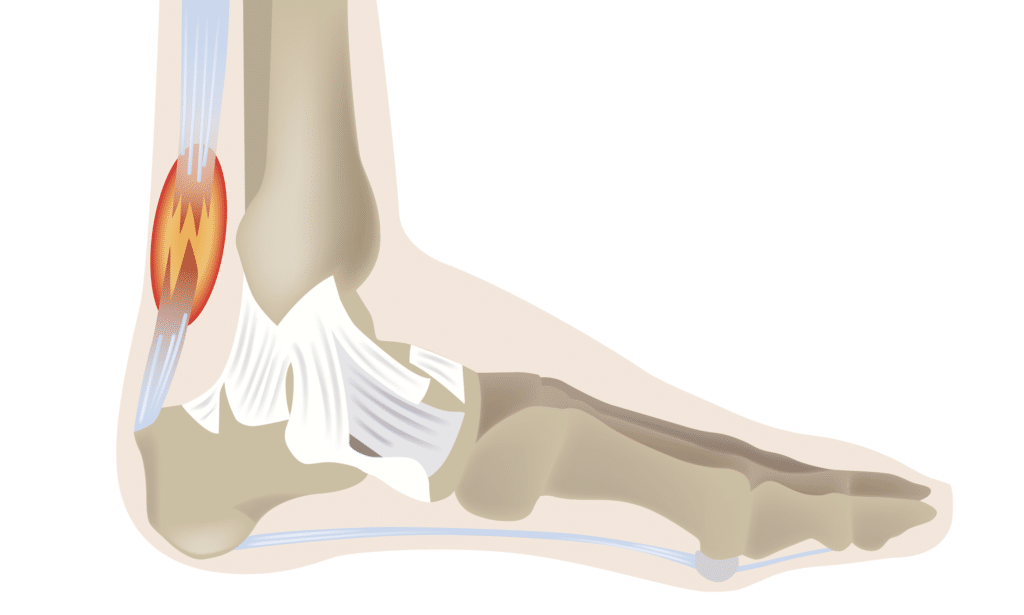 la rottura del tendine d'achille
