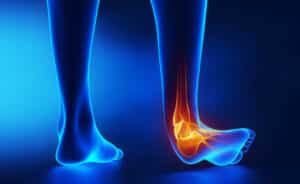 distorsione di caviglia eversione