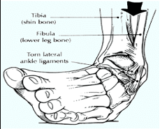 distorsione di caviglia inversione
