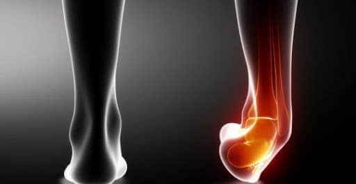 distorsione di caviglia