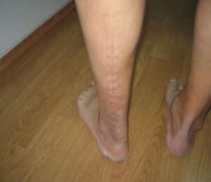 rottura del tendine d'achille ricostruzione