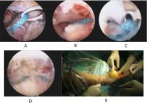 rottura del tendine d'achille ricostruzione endoscopica