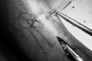 rottura del tendine d'achille ricostruzione tecnica mini open