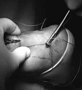 rottura del tendine d'achille ricostruzione tecnica mini open