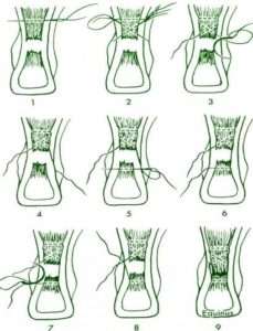 rottura del tendine d'achille ricostruzione tecnica percutanea
