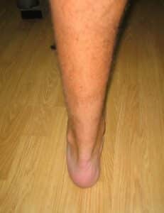 rottura del tendine d'achille ricostruzione tecnica percutanea