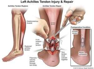 rottura del tendine d'achille ricostruzione