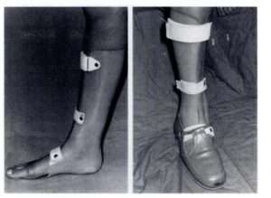 rottura del tendine d'achille splint