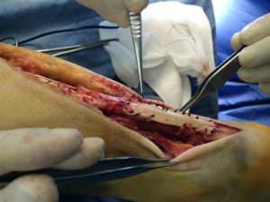 rottur tendine d'achille intervento chirurgico