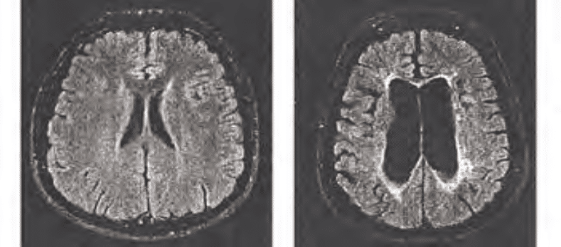 sclerosi multipla mielina