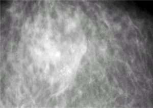 tumore al seno calcificazioni