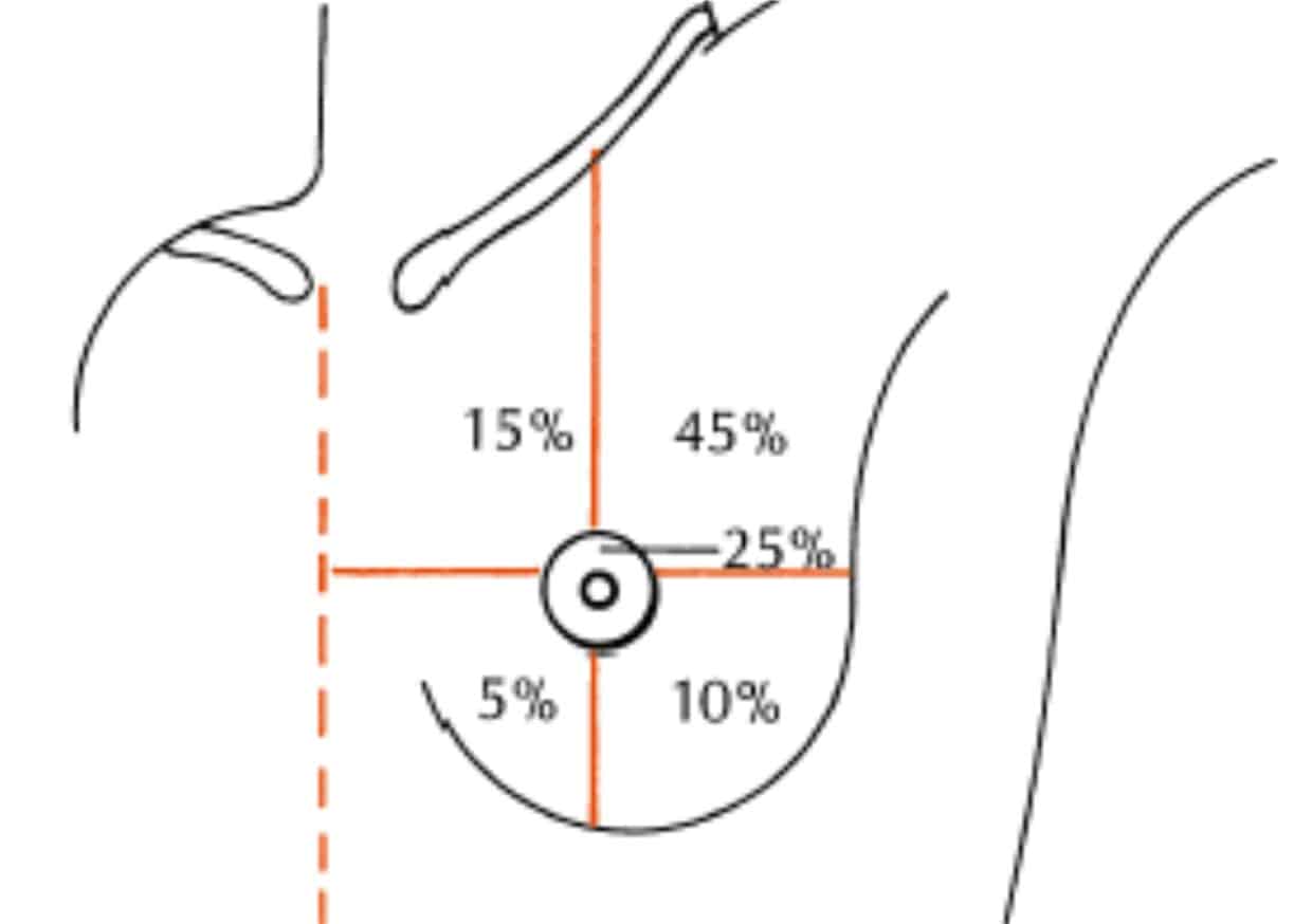 tumore al seno distribuzione