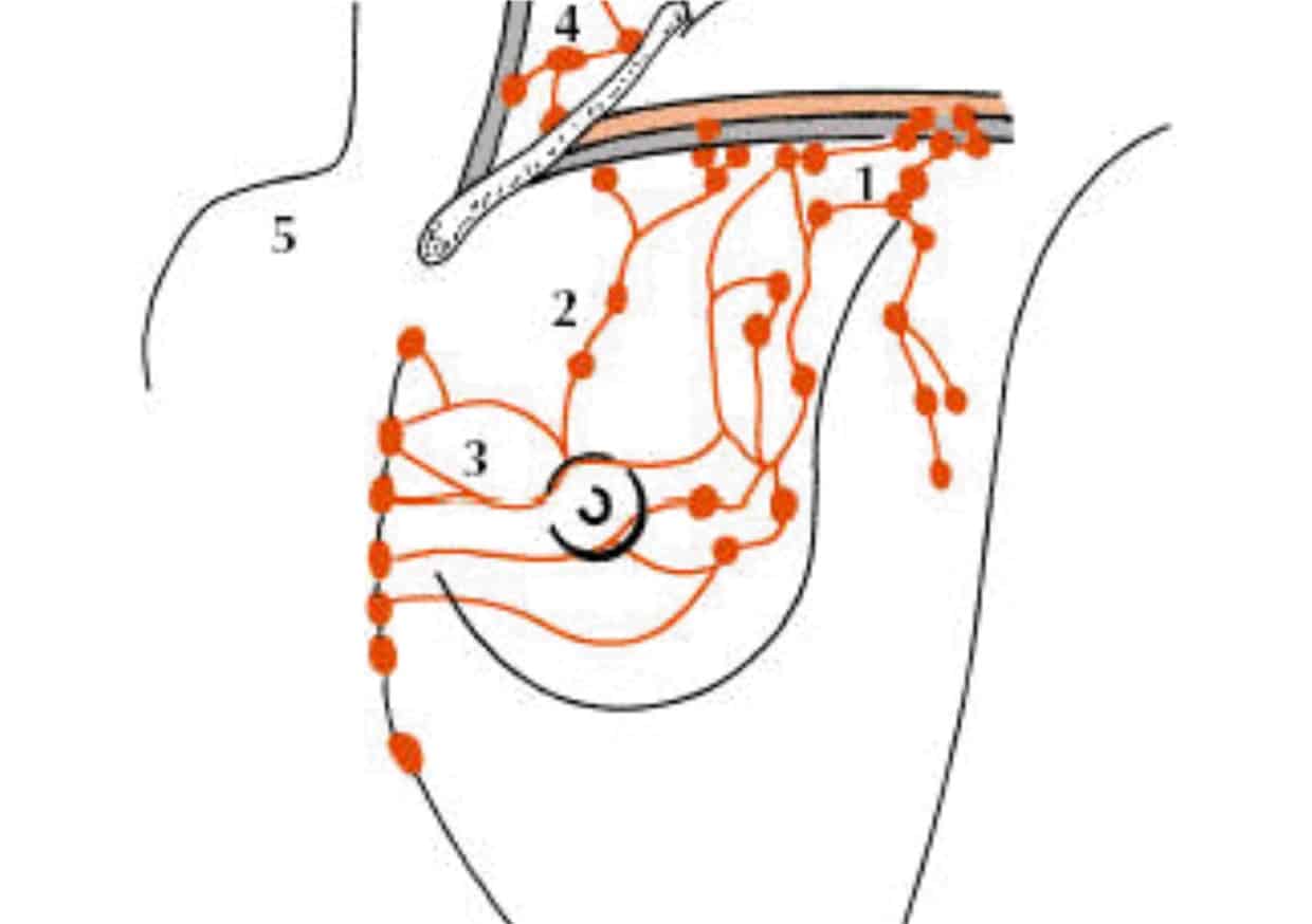 tumore al seno linfonodi