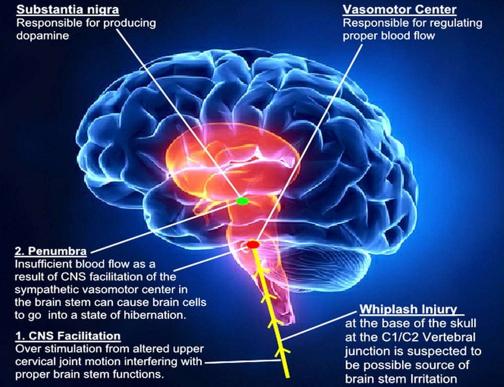 il-morbo-di-parkinson