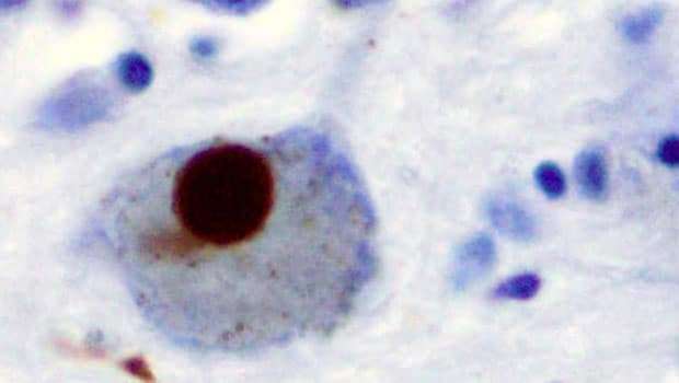 il morbo di parkinson corpi di lewy in una cellula cerebrale.