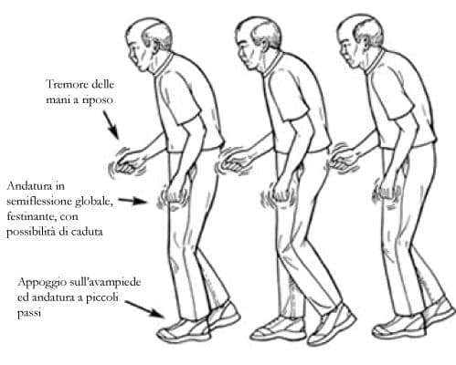 il-morbo-di-parkinson