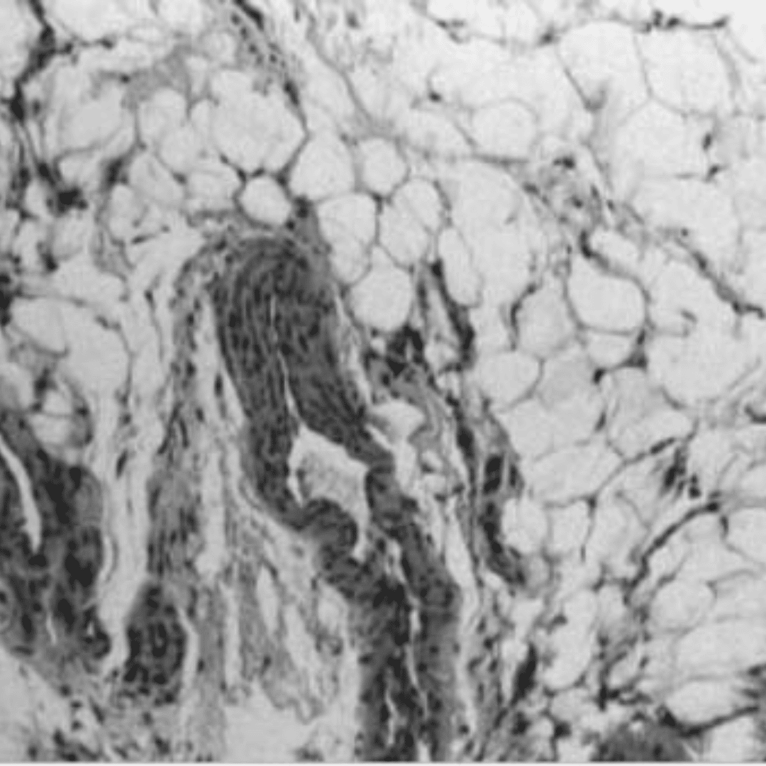 epicondilite aspetto istologico