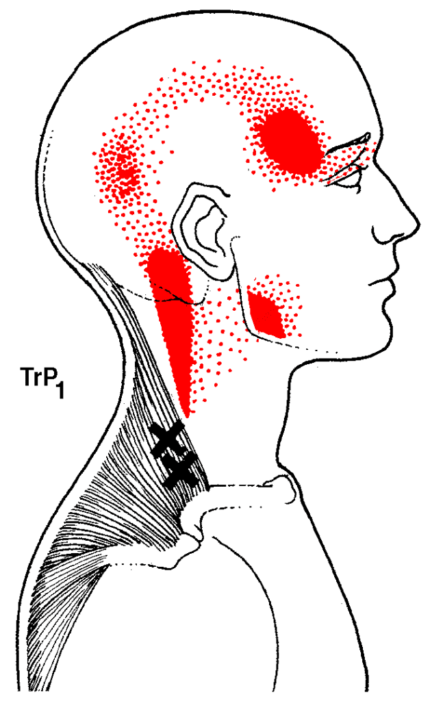 Trigger Points