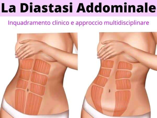 La diastasi addominale corso ecm per fisioterapisti